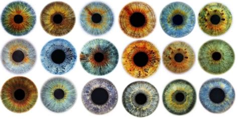 Central heterochromia (two different eye colors): Causes .